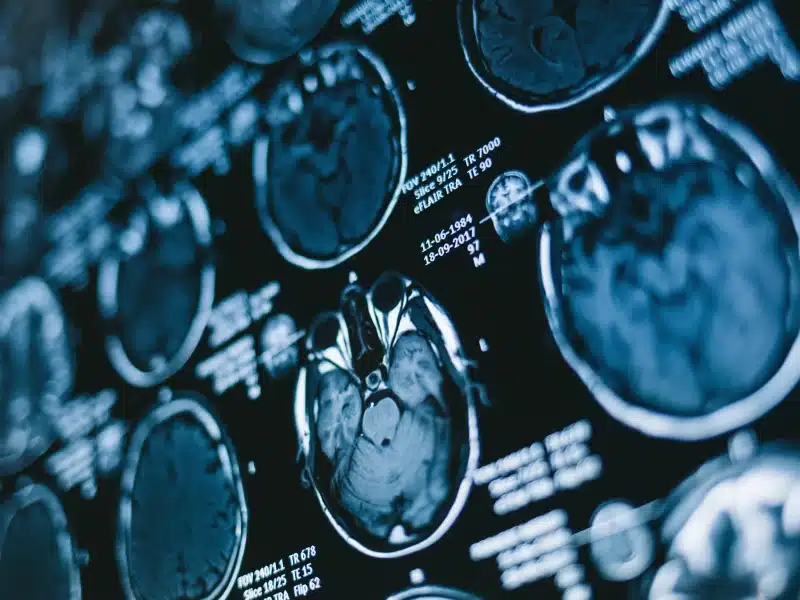 MRI